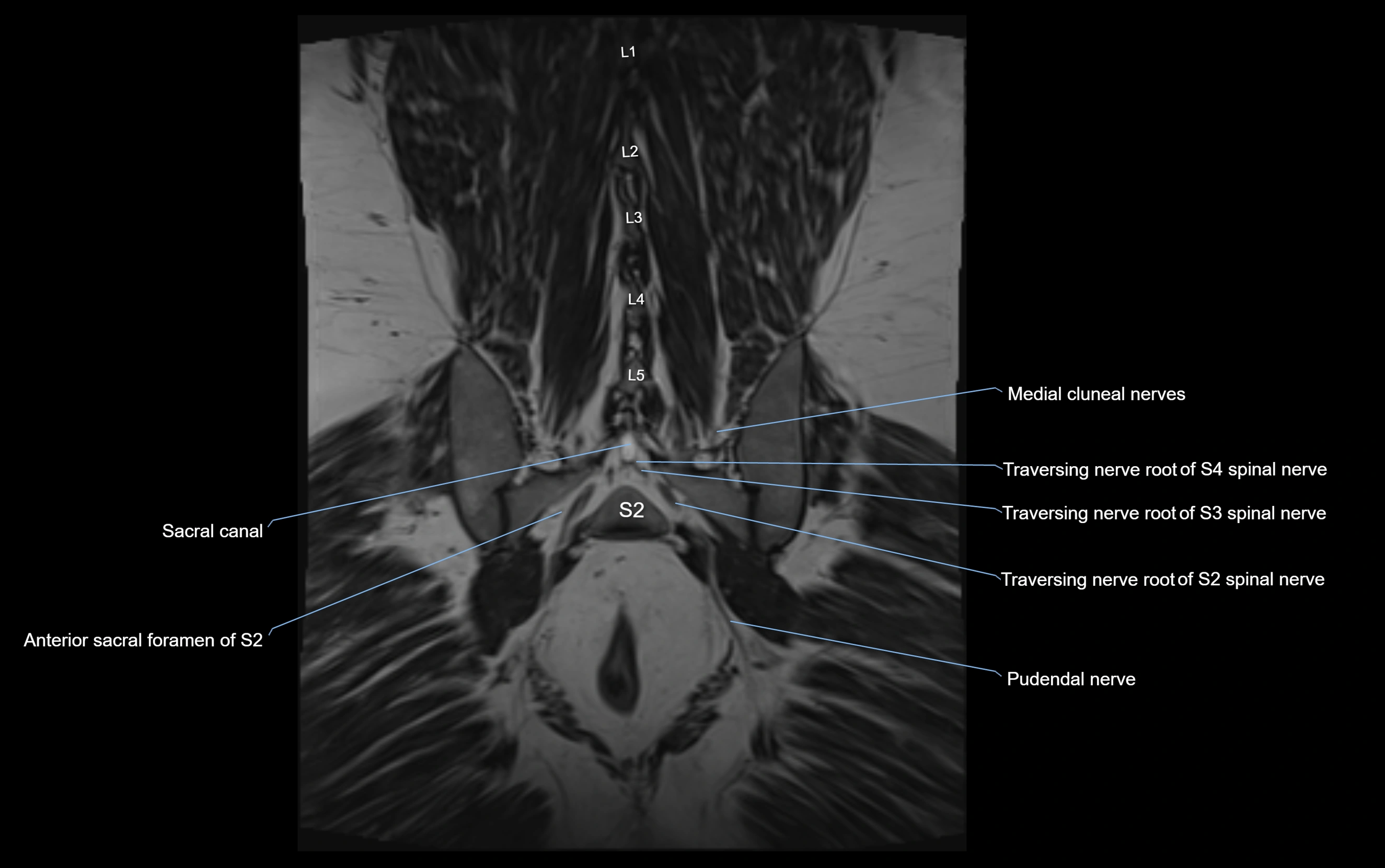 MR lumbosacral plexus cross sectional anatomy 3T  radiology  image-img-09001-00063.webp